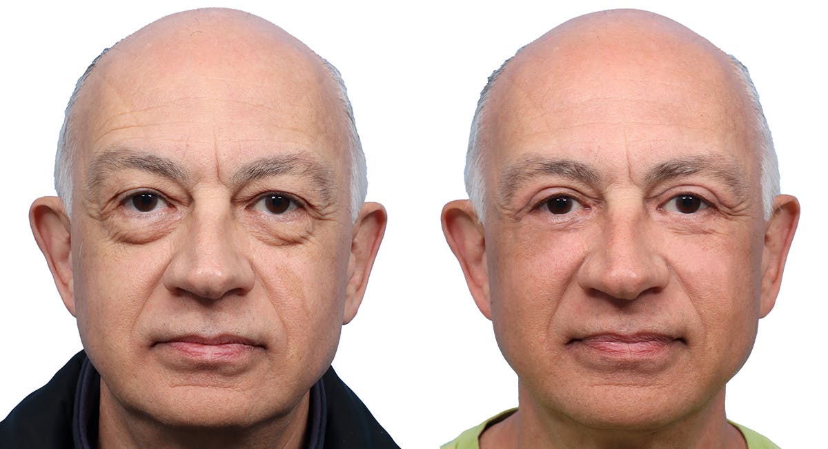 Blepharoplasty (Eyelid Surgery) Before & After Gallery - Patient 163451 - Image 1