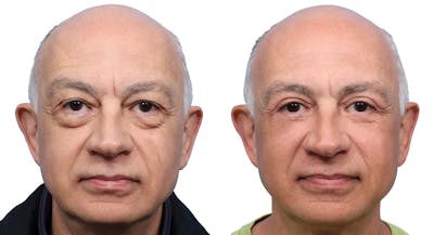 Blepharoplasty (Eyelid Surgery) Before & After Gallery - Patient 163451 - Image 1