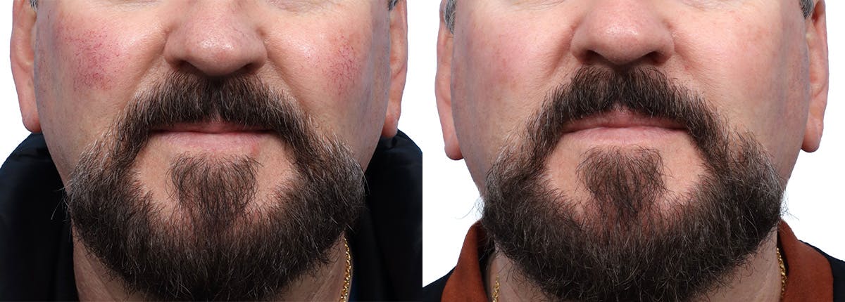 VBeam® Before & After Gallery - Patient 315065 - Image 1