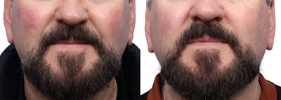 VBeam® Before & After Gallery - Patient 315065 - Image 1