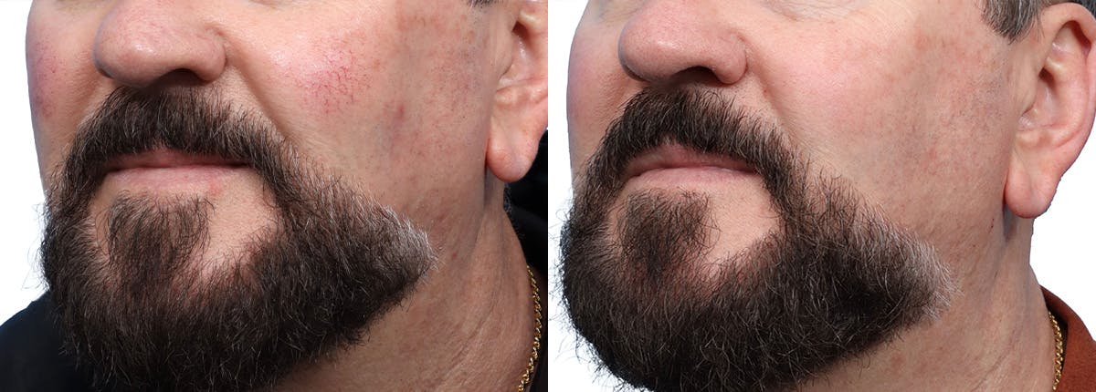 VBeam® Before & After Gallery - Patient 315065 - Image 3