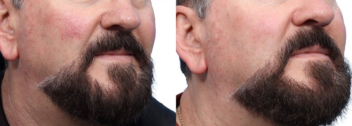 VBeam® Before & After Gallery - Patient 315065 - Image 2