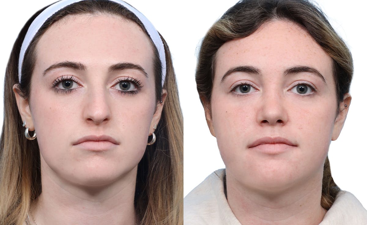 Rhinoplasty Before & After Gallery - Patient 251424 - Image 3