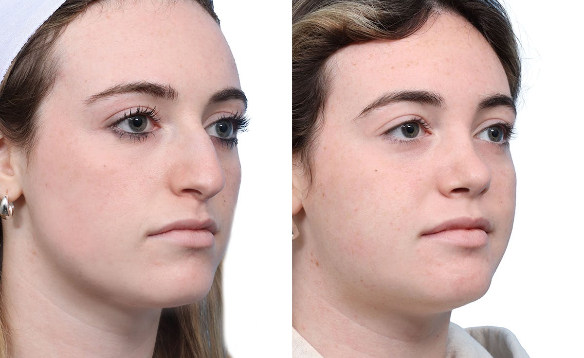 Rhinoplasty Before & After Gallery - Patient 251424 - Image 2