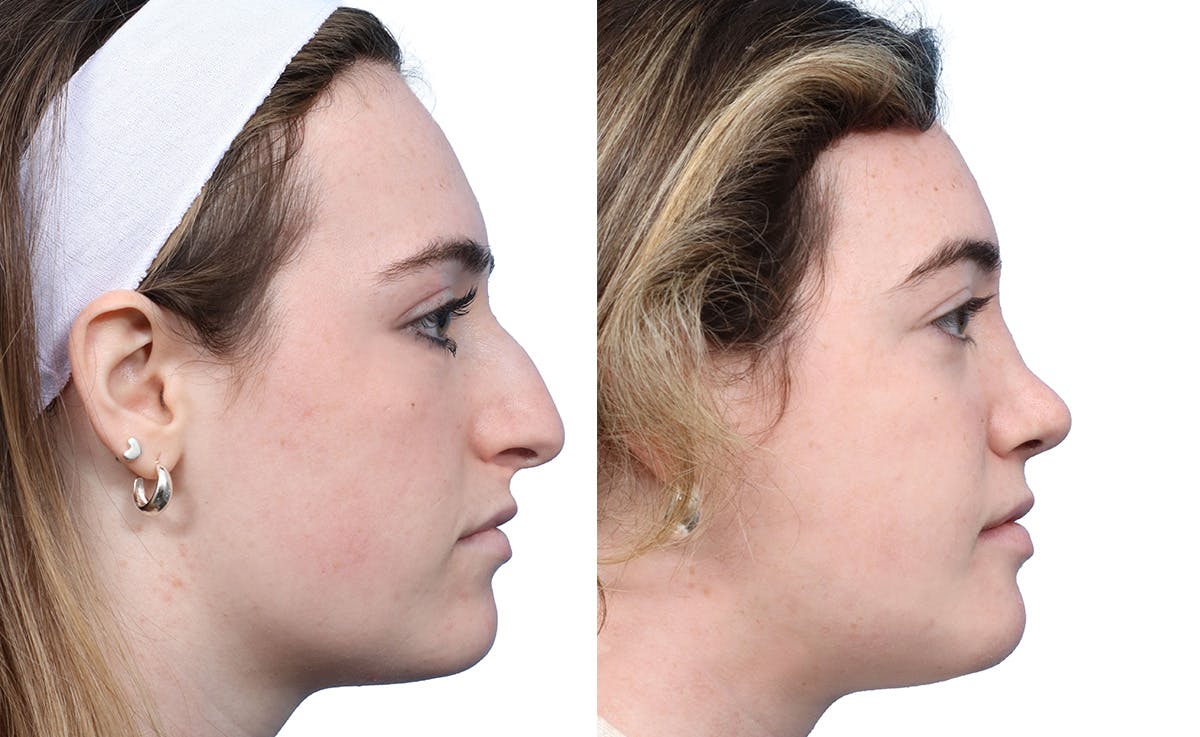 Rhinoplasty Before & After Gallery - Patient 251424 - Image 1