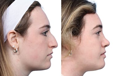 Rhinoplasty Before & After Gallery - Patient 251424 - Image 1