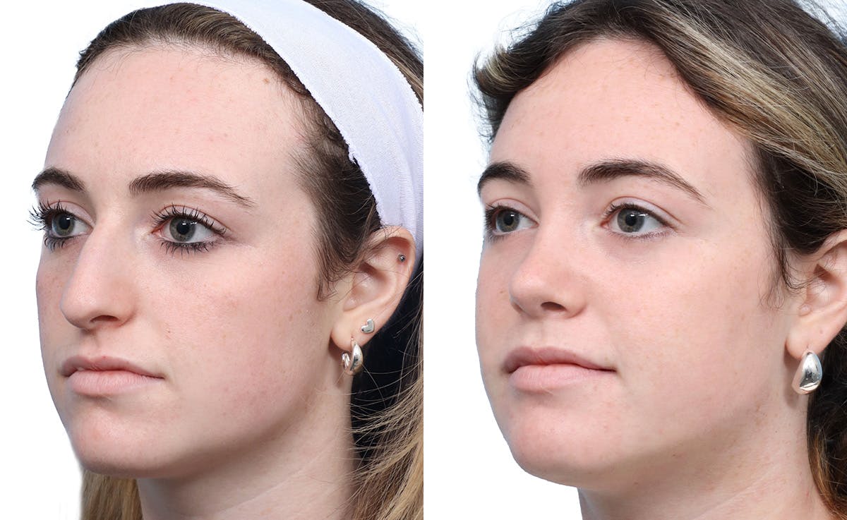 Rhinoplasty Before & After Gallery - Patient 251424 - Image 4