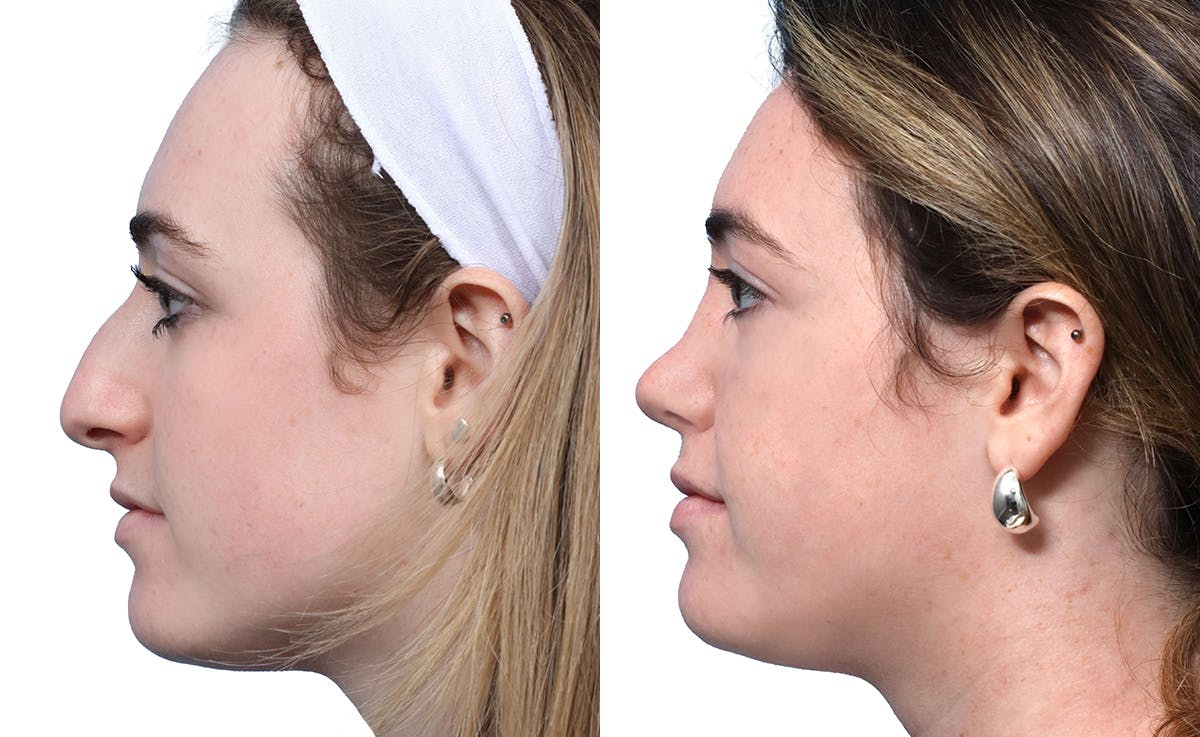 Rhinoplasty Before & After Gallery - Patient 251424 - Image 5