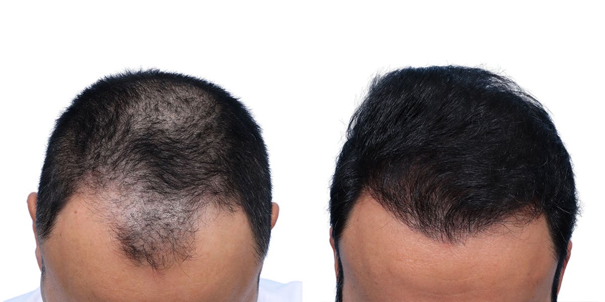 FUE Hair Transplant Before & After Gallery - Patient 280259 - Image 2