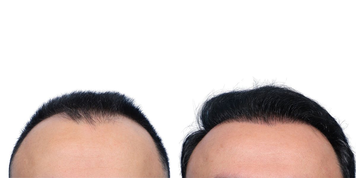 FUE Hair Transplant Before & After Gallery - Patient 280259 - Image 1