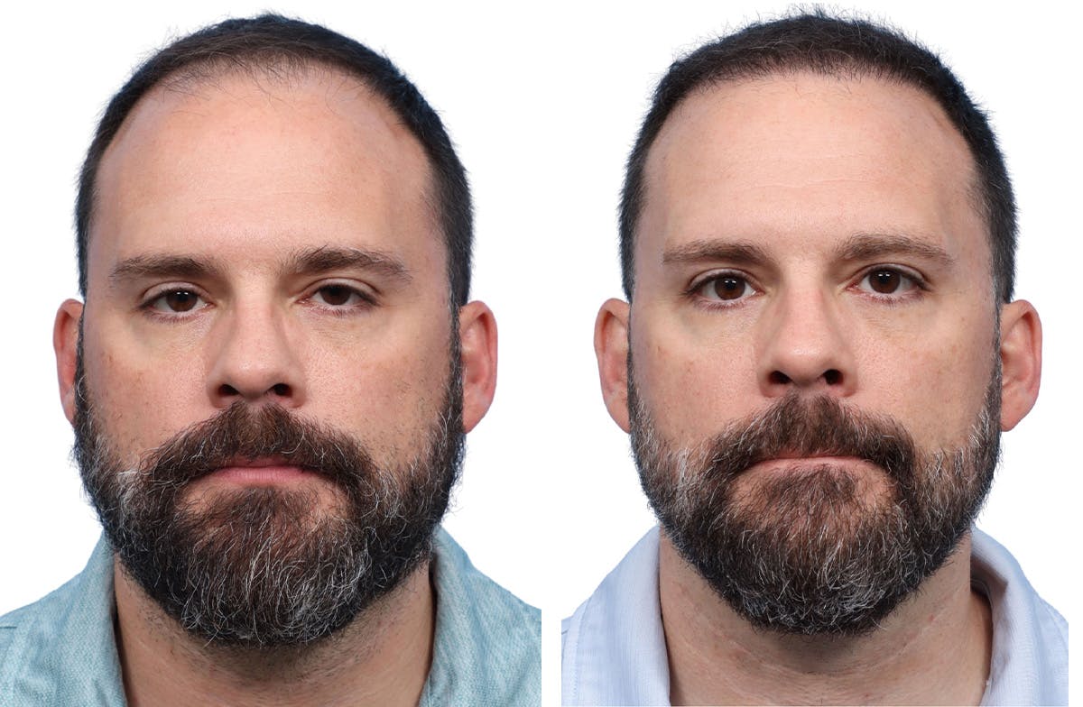 FUE Hair Transplant Before & After Gallery - Patient 366516 - Image 1
