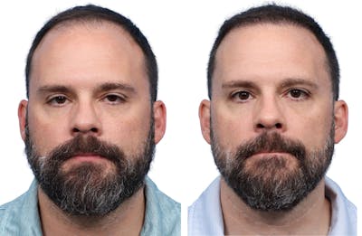 FUE Hair Transplant Before & After Gallery - Patient 366516 - Image 1
