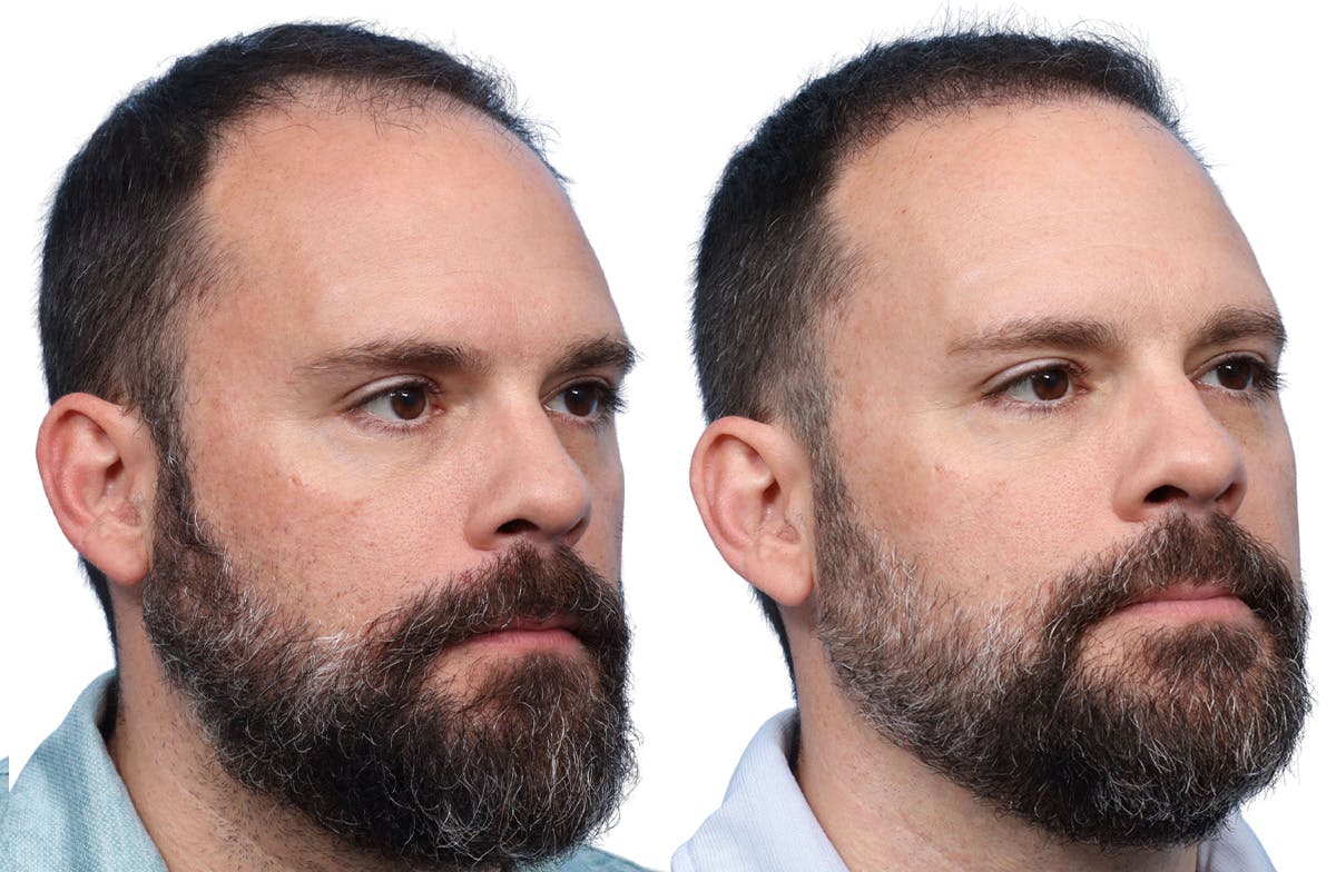 FUE Hair Transplant Before & After Gallery - Patient 366516 - Image 3