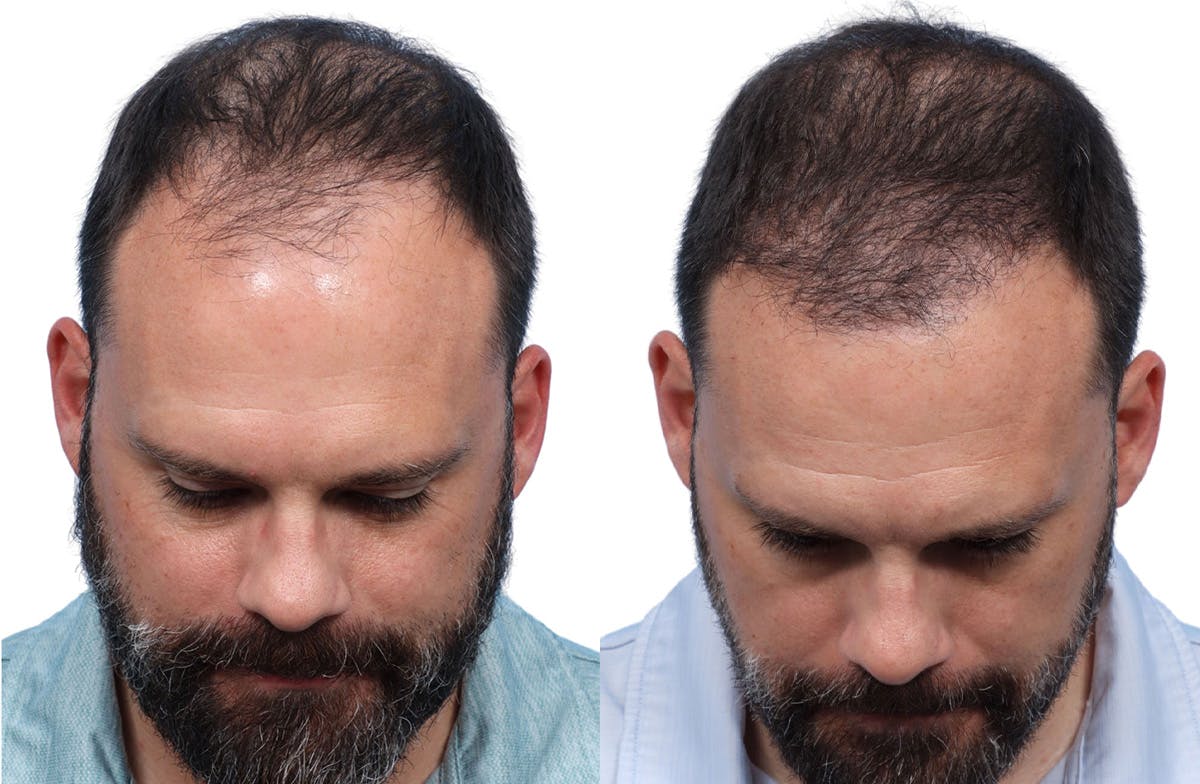 FUE Hair Transplant Before & After Gallery - Patient 366516 - Image 2