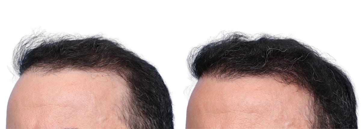FUE Hair Transplant Before & After Gallery - Patient 371655 - Image 3