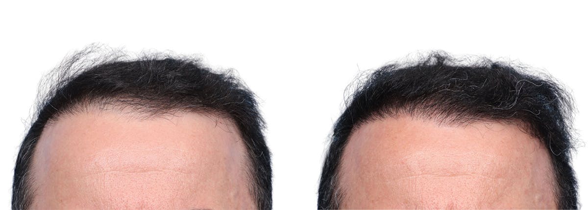 FUE Hair Transplant Before & After Gallery - Patient 371655 - Image 1