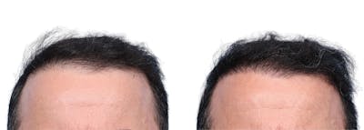 FUE Hair Transplant Before & After Gallery - Patient 371655 - Image 1