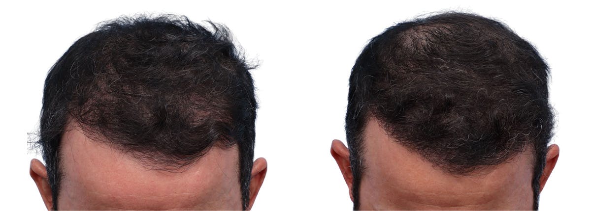 FUE Hair Transplant Before & After Gallery - Patient 371655 - Image 4