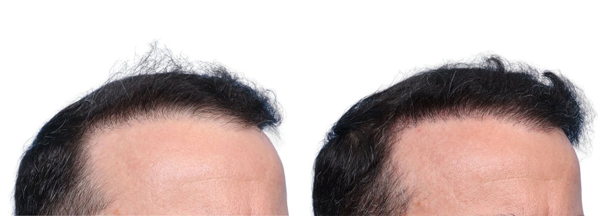 FUE Hair Transplant Before & After Gallery - Patient 371655 - Image 2