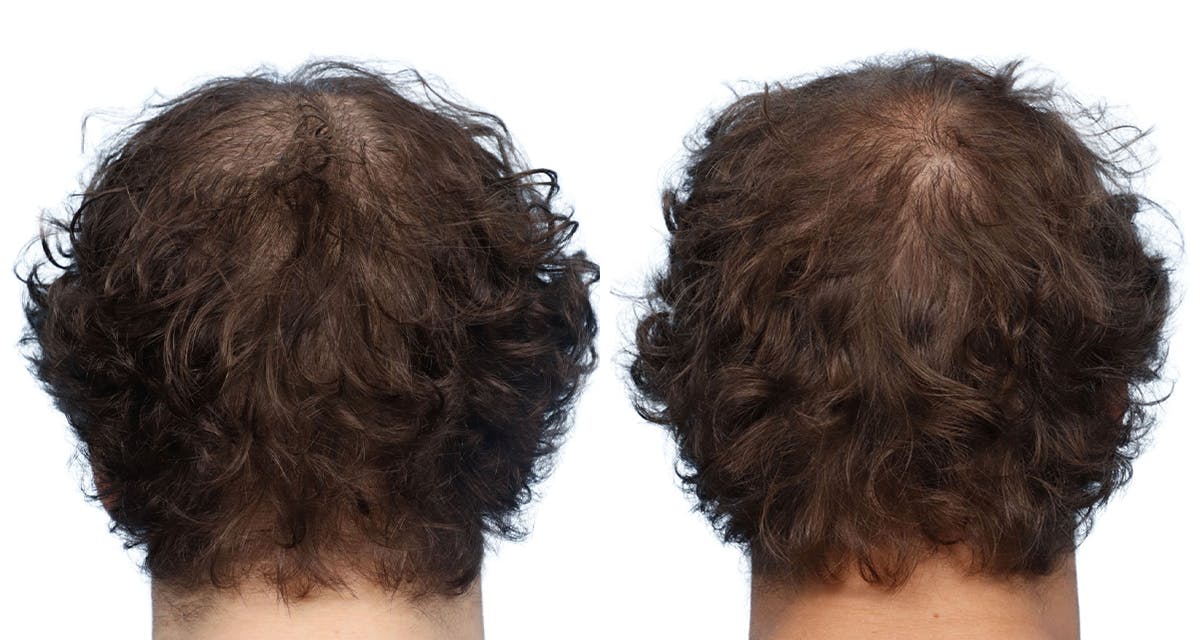 Platelet-Rich-Plasma Before & After Gallery - Patient 344078 - Image 1