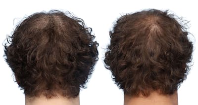 Platelet-Rich-Plasma Before & After Gallery - Patient 344078 - Image 1