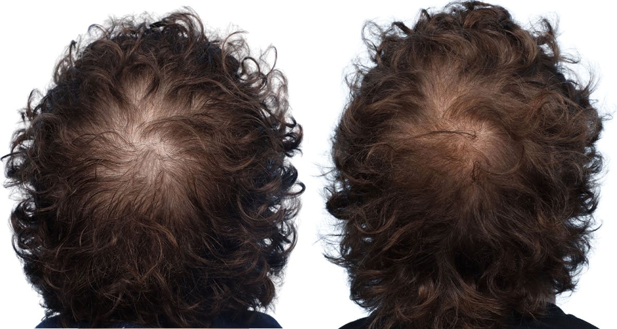 Platelet-Rich-Plasma Before & After Gallery - Patient 344078 - Image 2