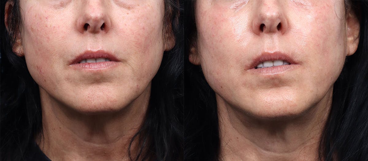 Morpheus8® Before & After Gallery - Patient 335746 - Image 1
