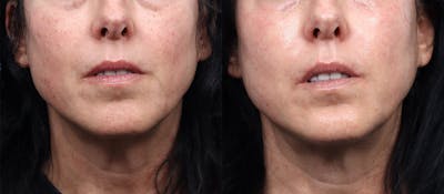 Morpheus8® Before & After Gallery - Patient 335746 - Image 1