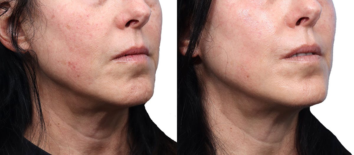 Morpheus8® Before & After Gallery - Patient 335746 - Image 2