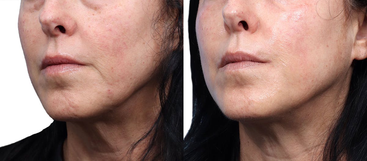 Morpheus8® Before & After Gallery - Patient 335746 - Image 3