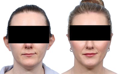 Otoplasty (Ear Surgery) Before & After Gallery - Patient 328732 - Image 1