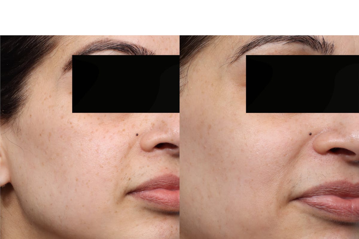 Picoway® Before & After Gallery - Patient 173751 - Image 2