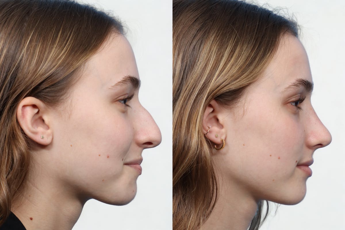 Rhinoplasty Before & After Gallery - Patient 363752 - Image 1