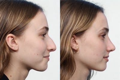 Rhinoplasty Before & After Gallery - Patient 363752 - Image 1