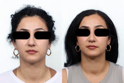 Rhinoplasty Before & After Gallery - Patient 230928 - Image 1