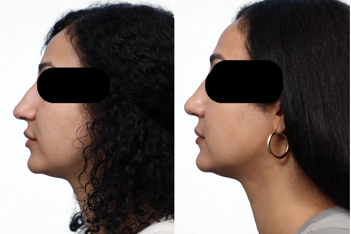 Rhinoplasty Before & After Gallery - Patient 230928 - Image 2