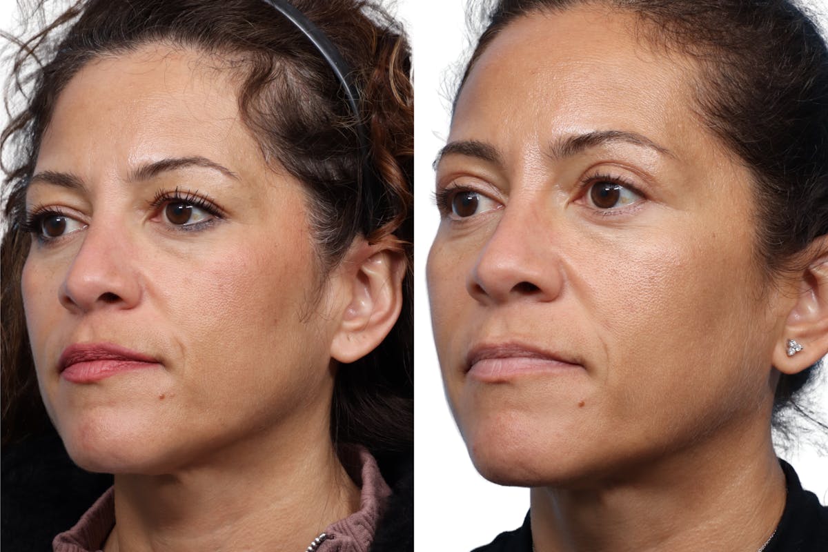 Blepharoplasty (Eyelid Surgery) Before & After Gallery - Patient 323971 - Image 2