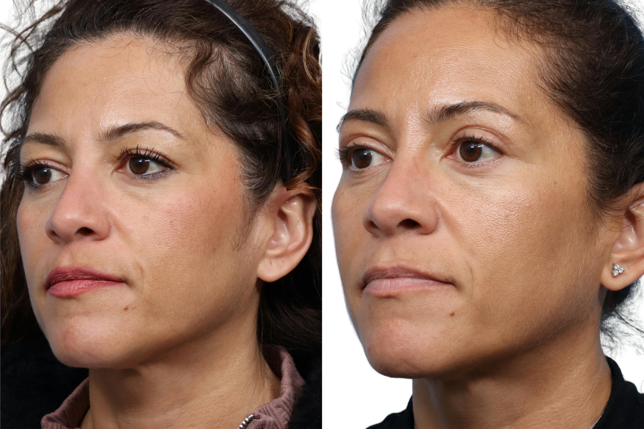 Blepharoplasty (Eyelid Surgery) Before & After Gallery - Patient 323971 - Image 2
