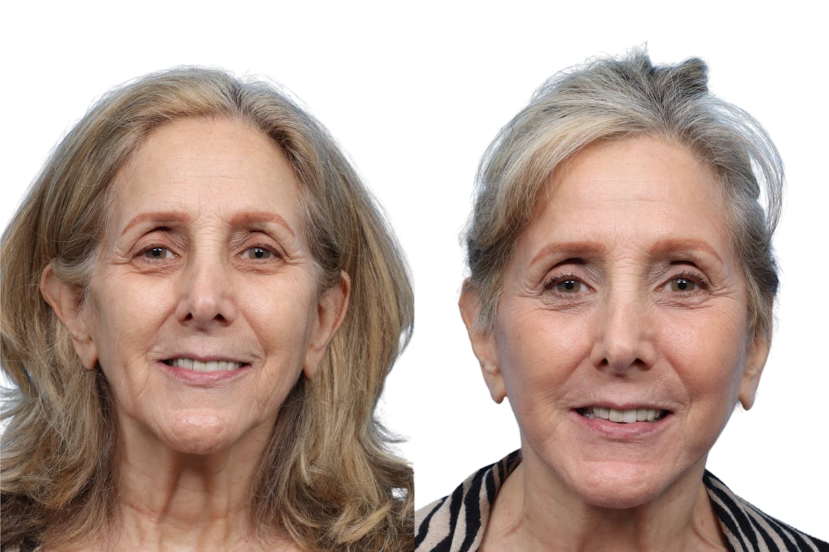 Facelift Before & After Gallery - Patient 198687 - Image 1