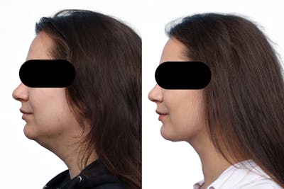 Submental Liposuction Before & After Gallery - Patient 230674 - Image 1