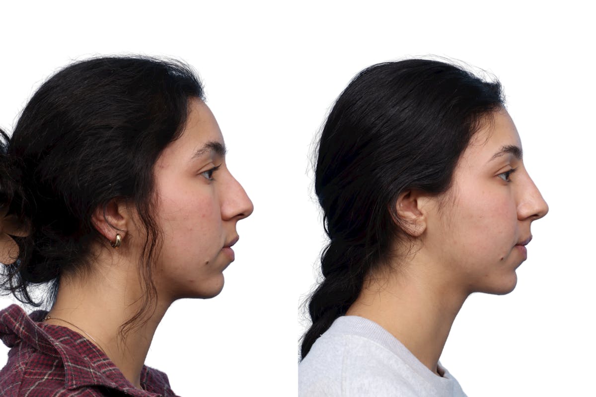 Non-Surgical Rhinoplasty Before & After Gallery - Patient 335371 - Image 1