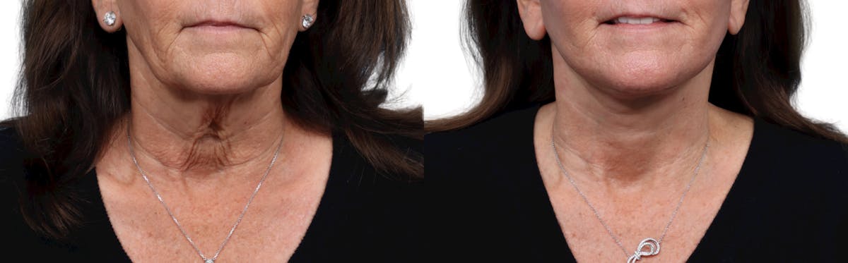 Facelift Before & After Gallery - Patient 324446 - Image 1