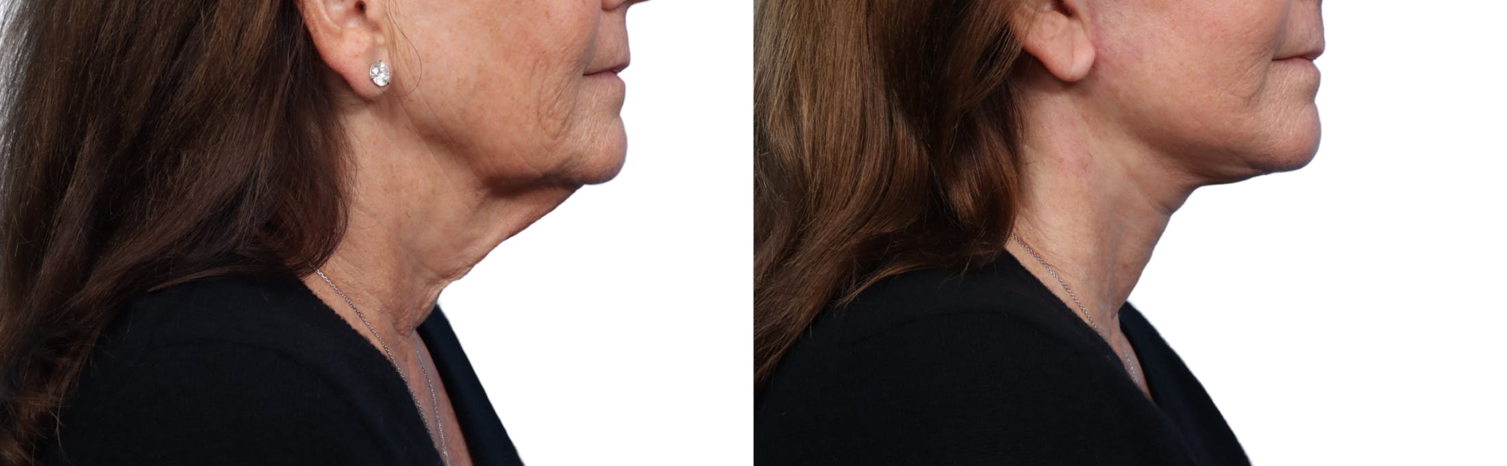 Facelift Before & After Gallery - Patient 324446 - Image 3