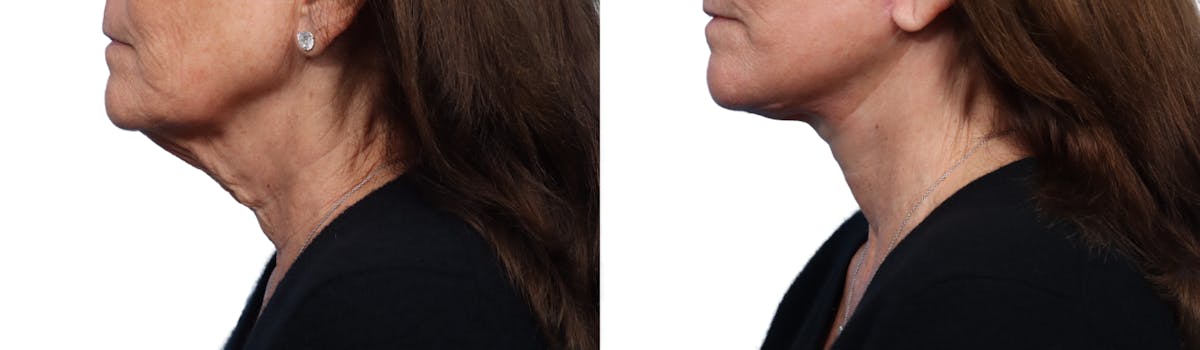 Facelift Before & After Gallery - Patient 324446 - Image 2