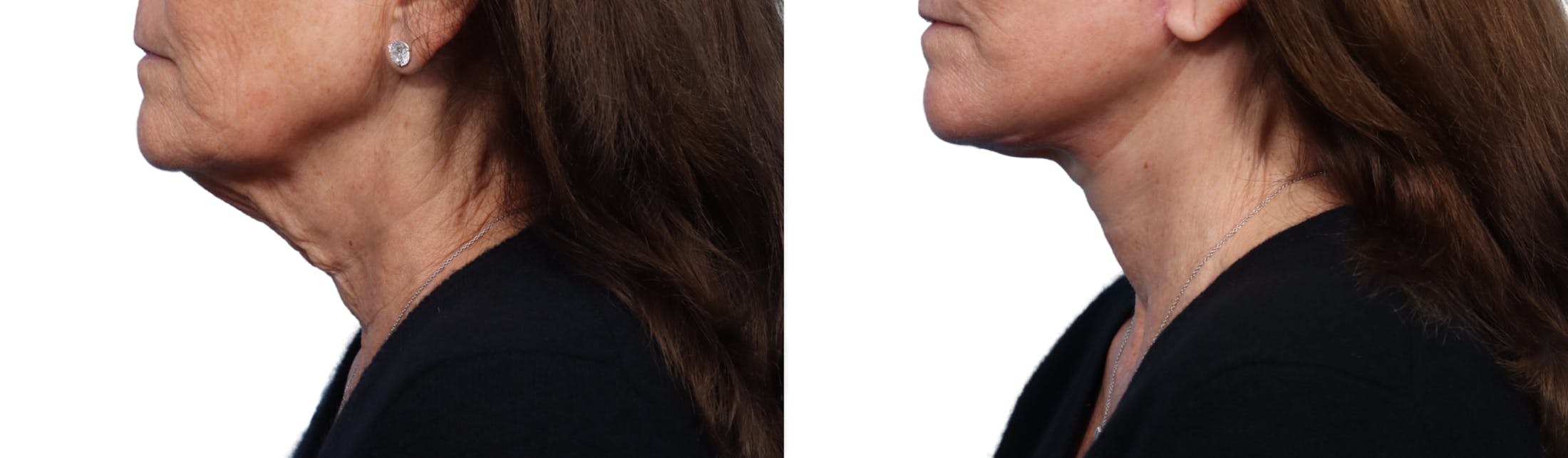 Facelift Before & After Gallery - Patient 324446 - Image 2