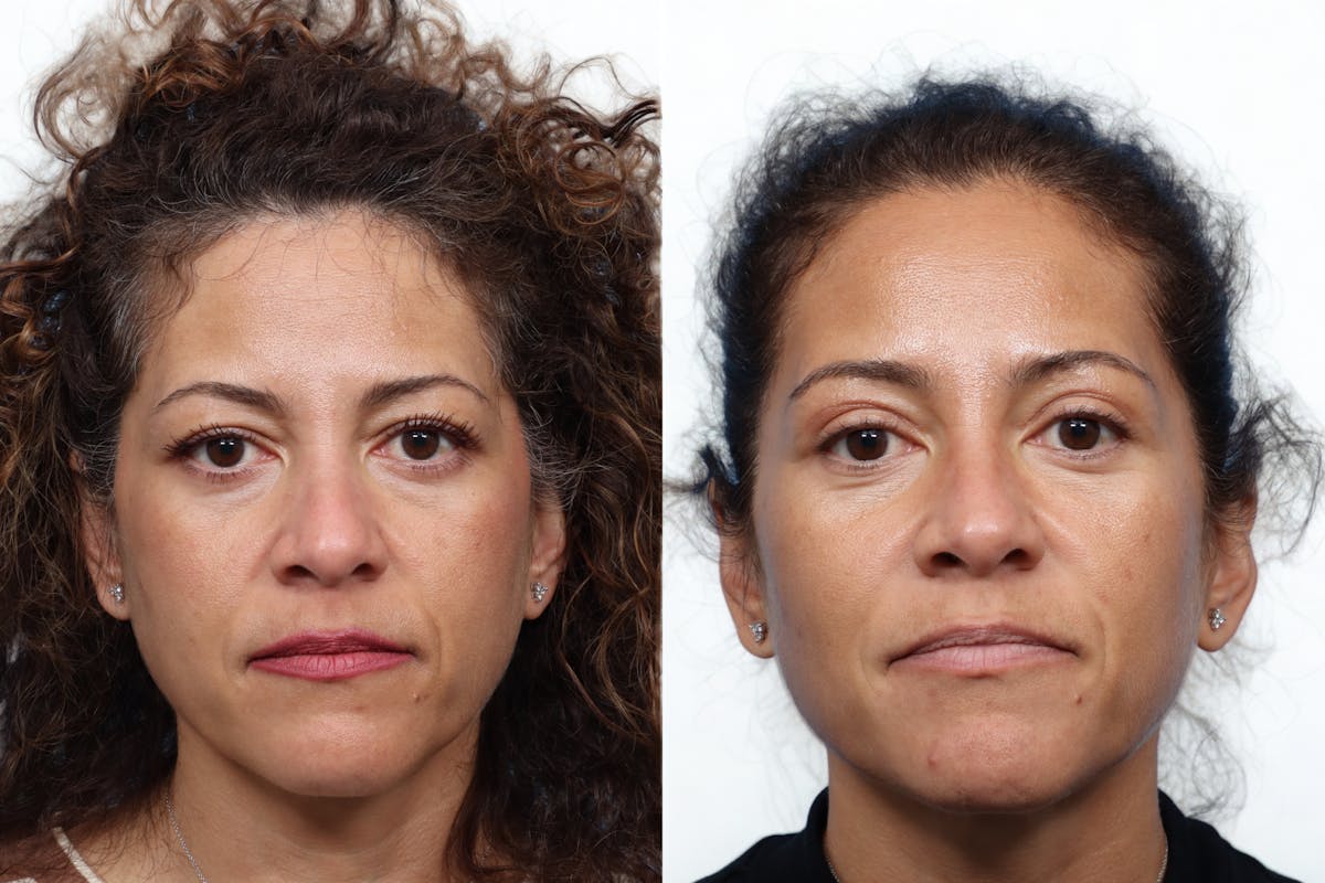 Blepharoplasty (Eyelid Surgery) Before & After Gallery - Patient 323971 - Image 1