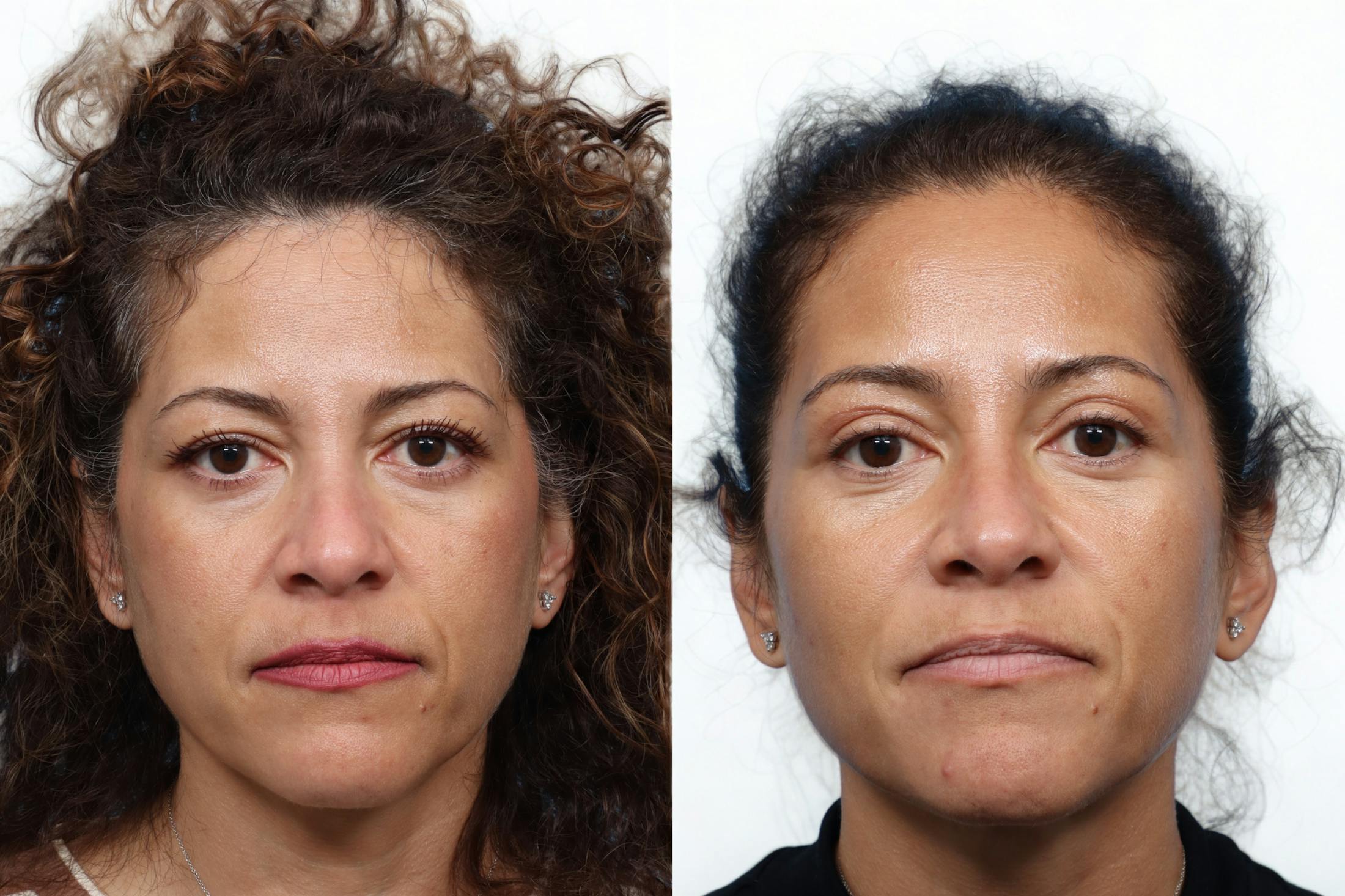 Blepharoplasty (Eyelid Surgery) Before & After Gallery - Patient 323971 - Image 1