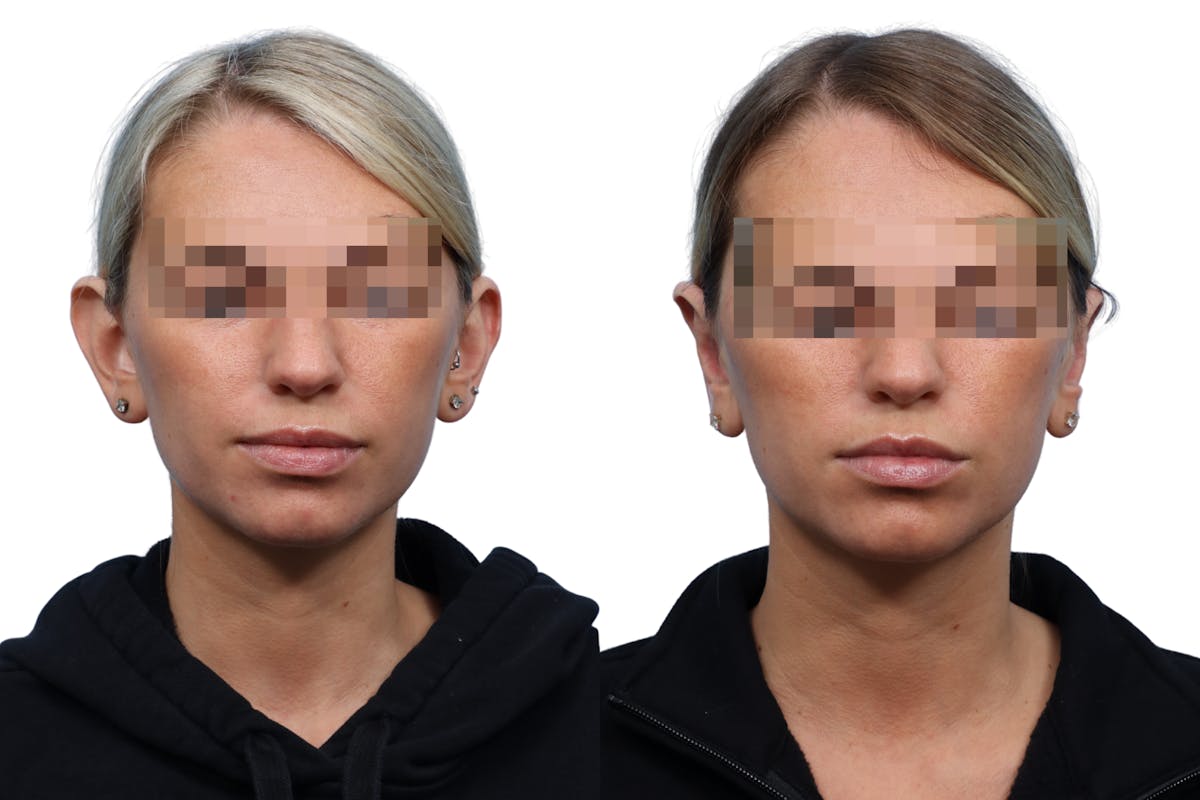 Otoplasty (Ear Surgery) Before & After Gallery - Patient 617133 - Image 2