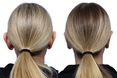 Otoplasty (Ear Surgery) Before & After Gallery - Patient 617133 - Image 1