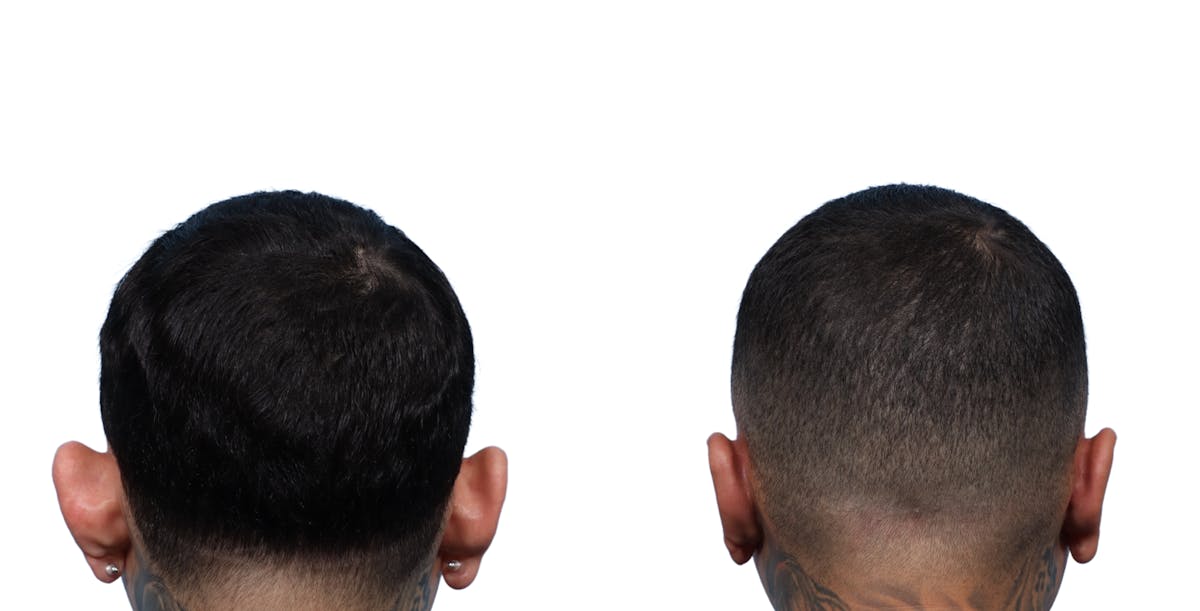 Otoplasty (Ear Surgery) Before & After Gallery - Patient 313508 - Image 1